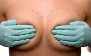 Breast augmentation - saline versus silicone implants
