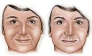 Newest trends in facelifts