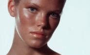 Natural treatments for acne and sunburn